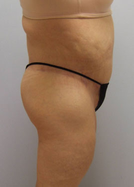 Body Lift Before & After Image