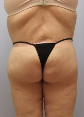 Body Lift Before & After Image