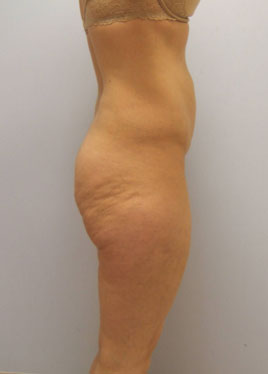 Body Lift Before & After Image