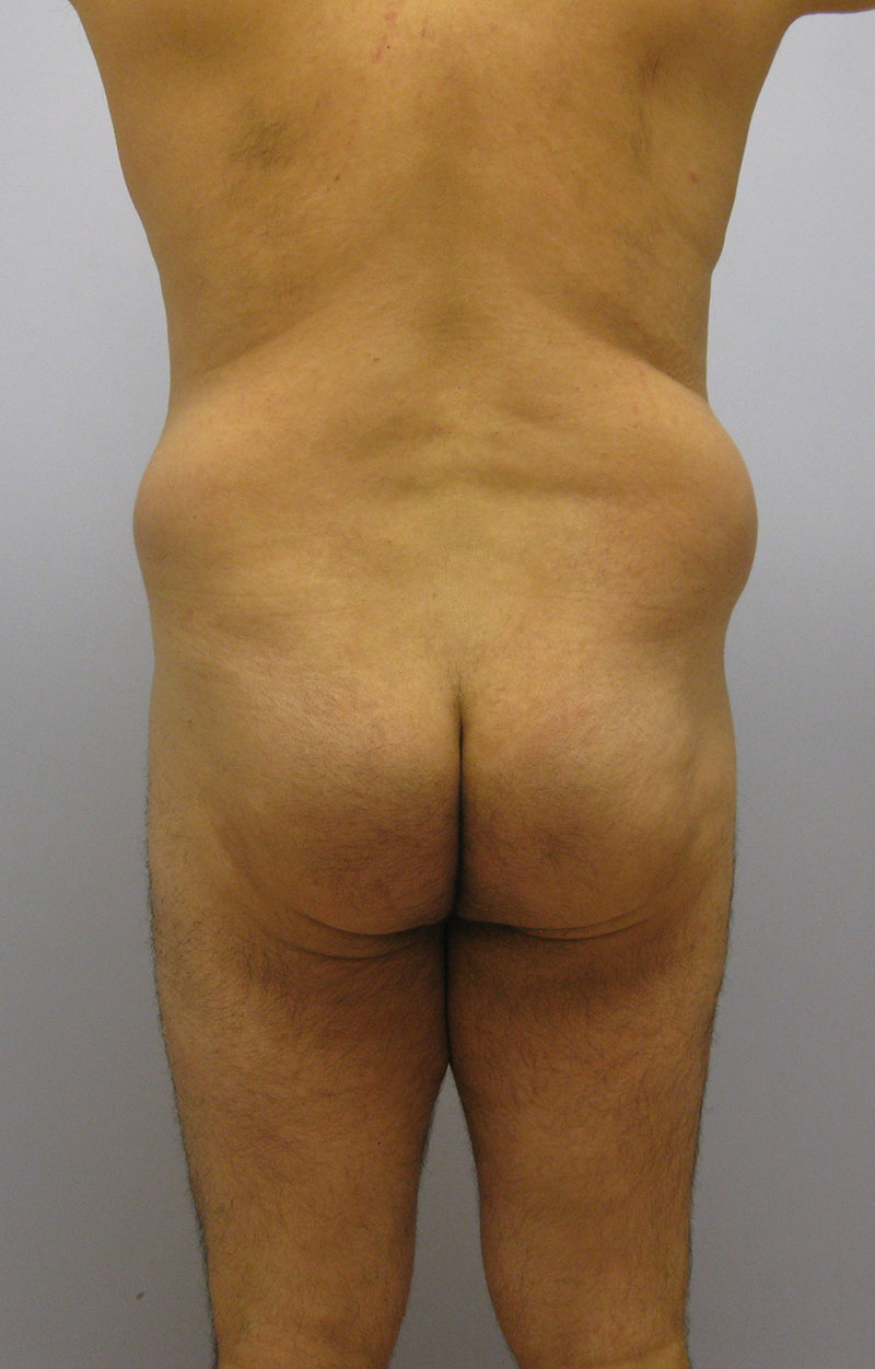 Body Lift Before & After Image