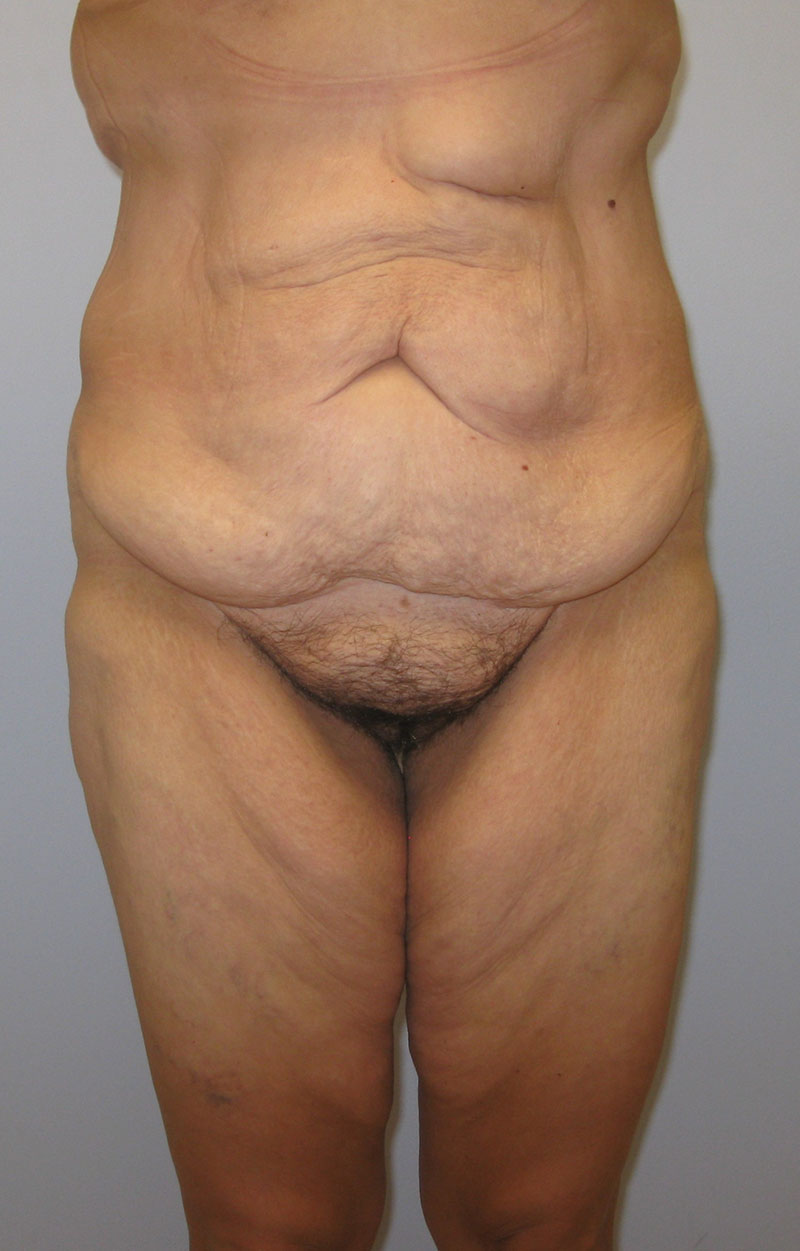 Body Lift Before & After Image