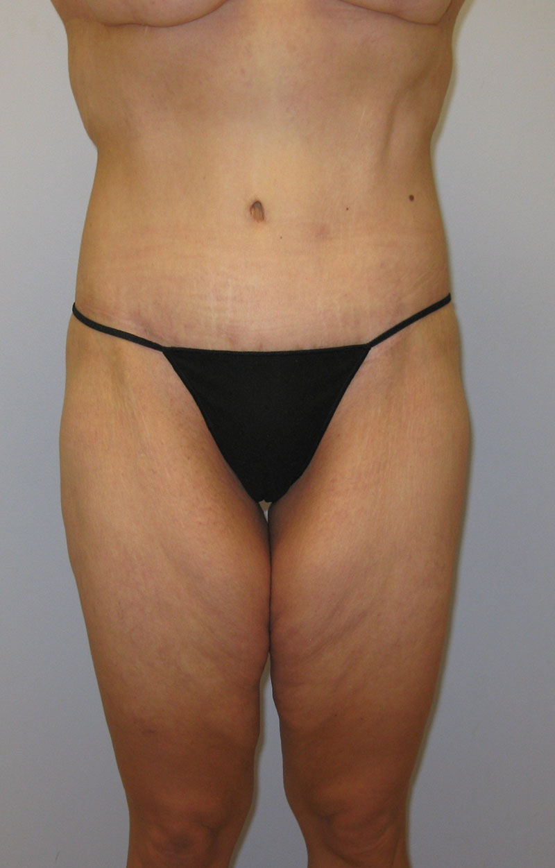 Body Lift Before & After Image