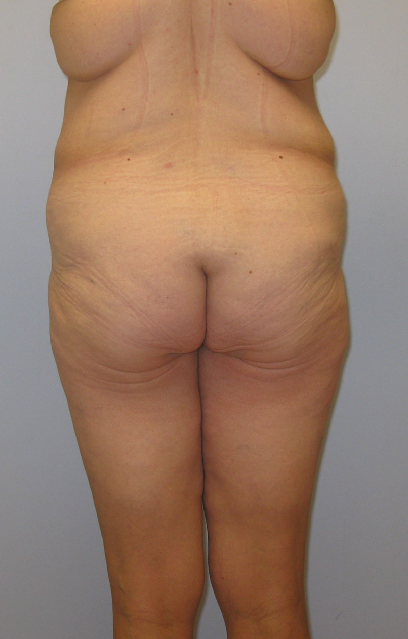 Body Lift Before & After Image