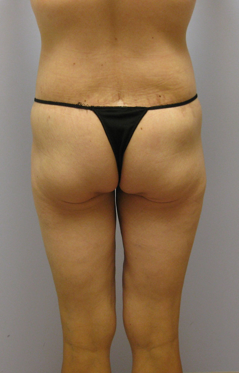 Body Lift Before & After Image