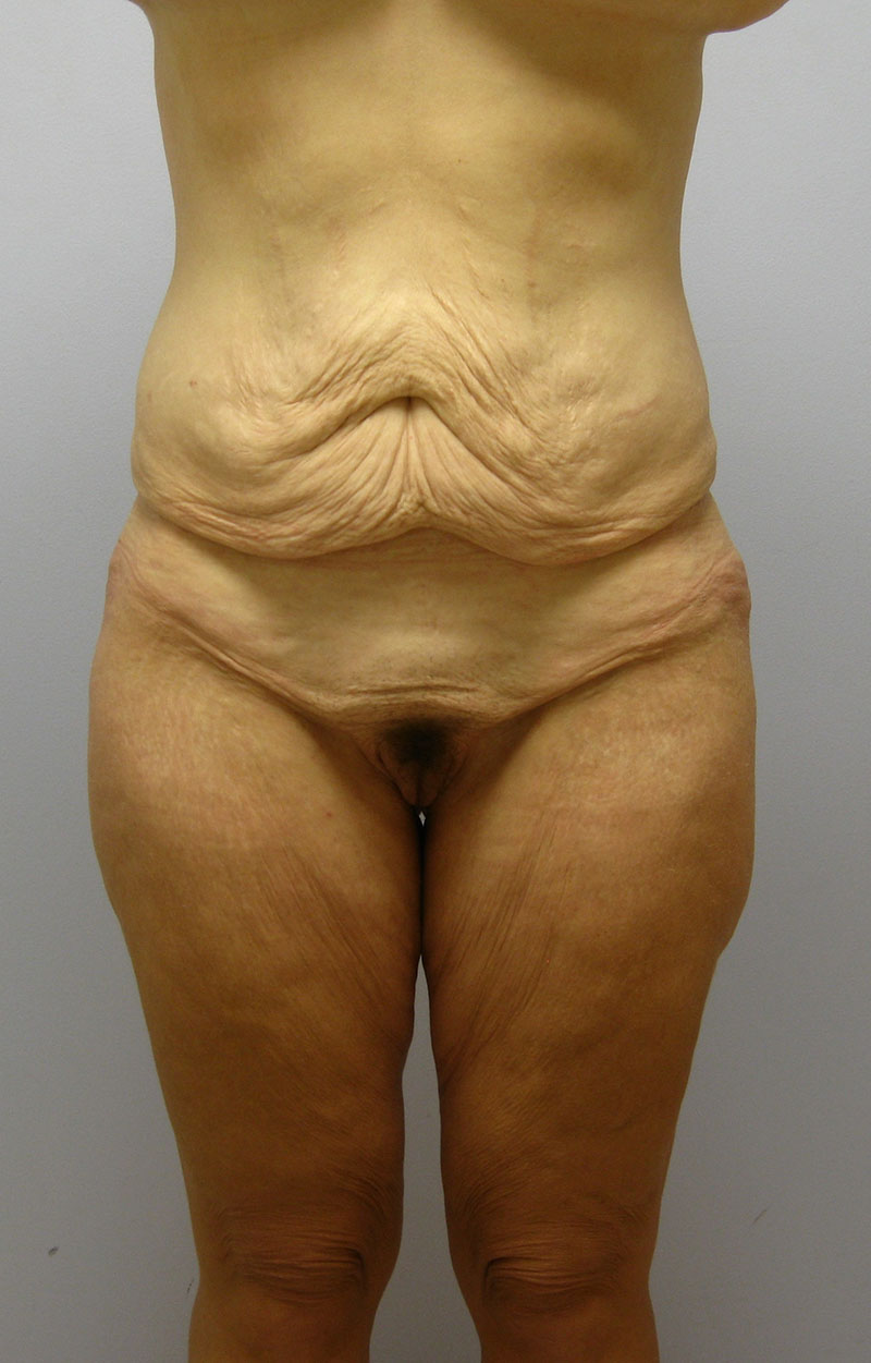 Body Lift Before & After Image