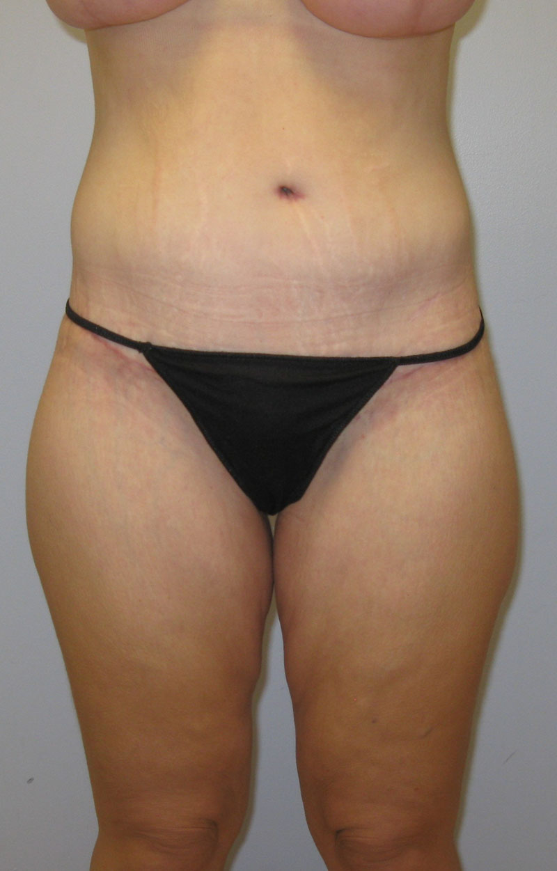 Body Lift Before & After Image