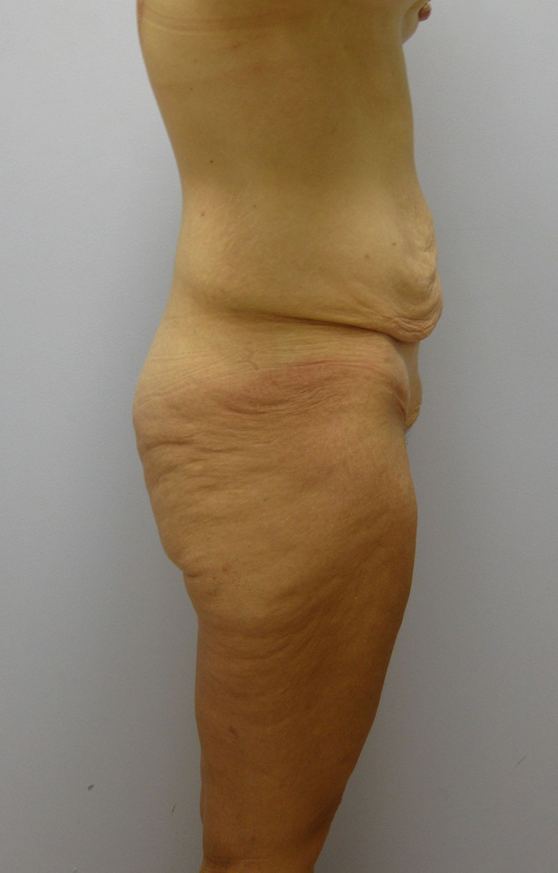 Body Lift Before & After Image