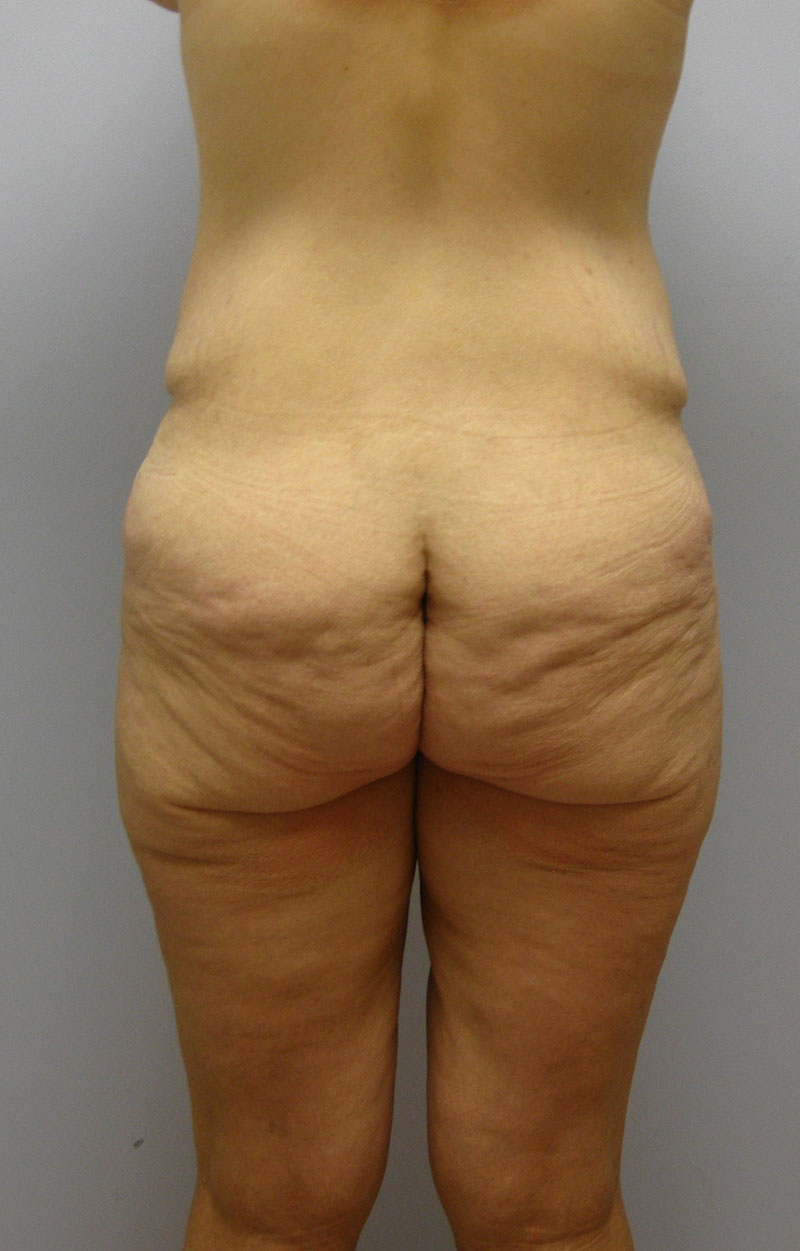 Body Lift Before & After Image