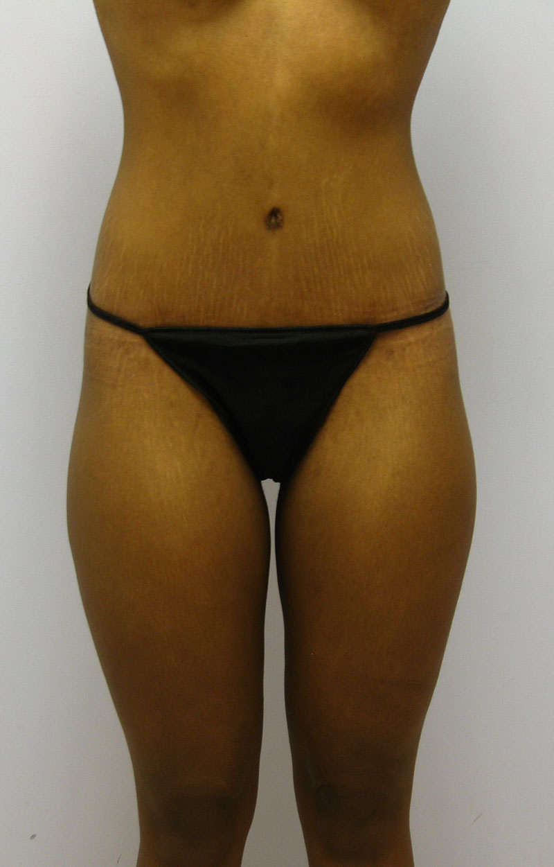 Body Lift Before & After Image