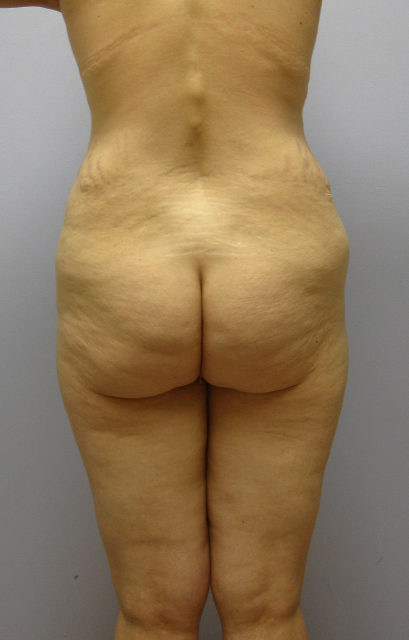 Body Lift Before & After Image