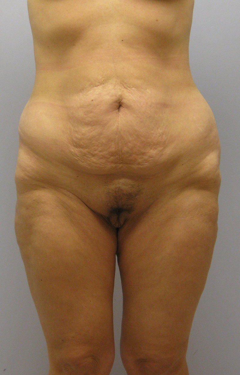 Body Lift Before & After Image