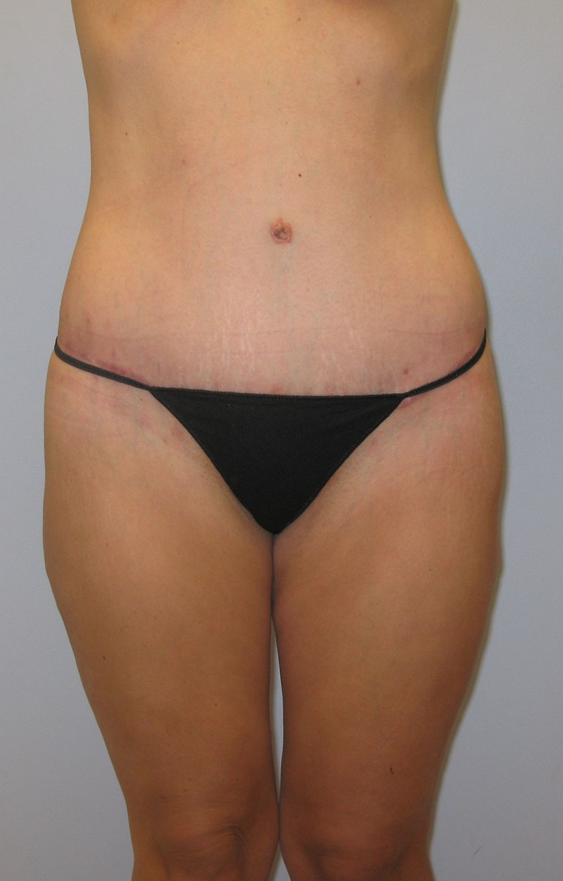 Body Lift Before & After Image