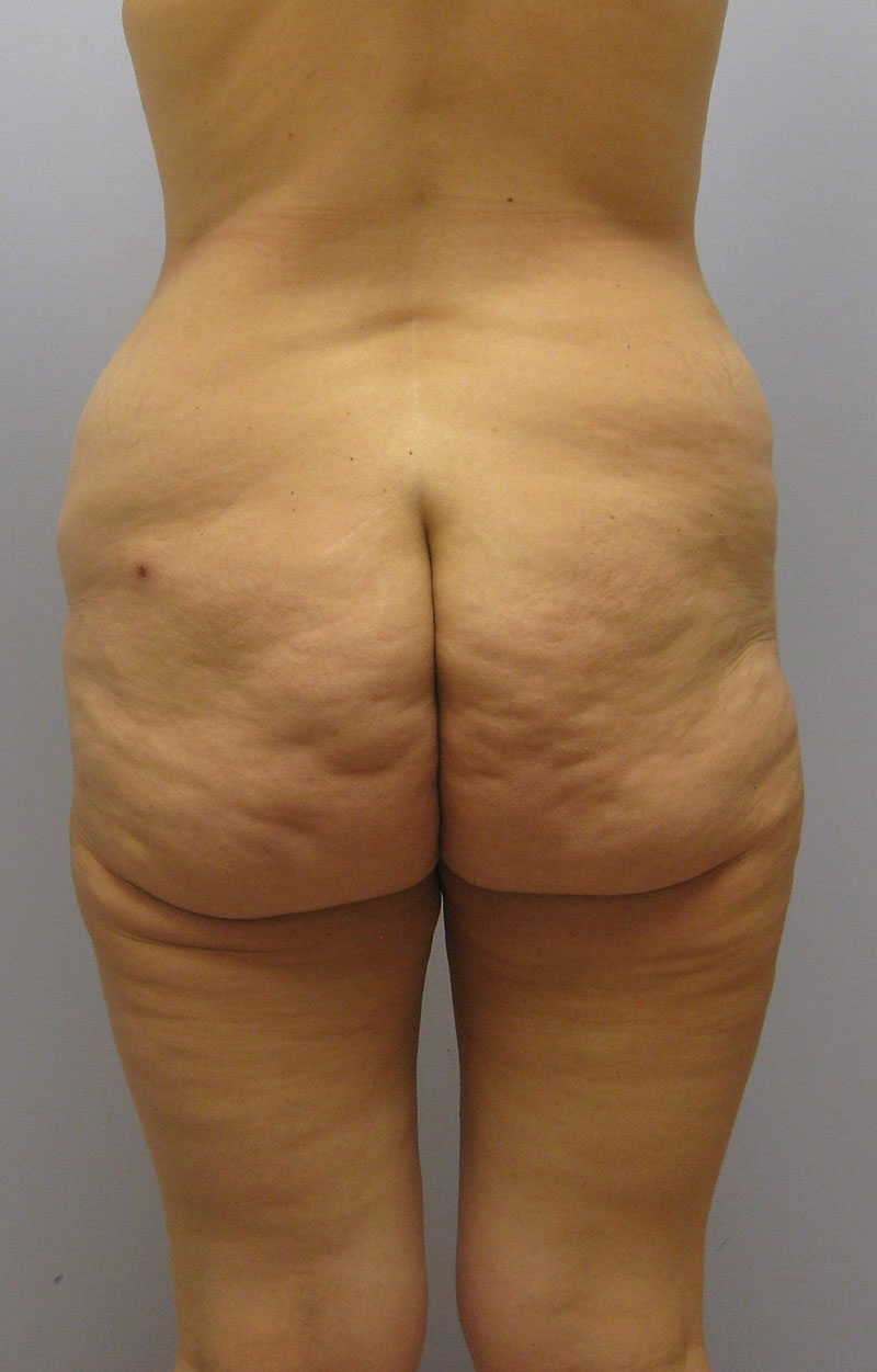 Body Lift Before & After Image