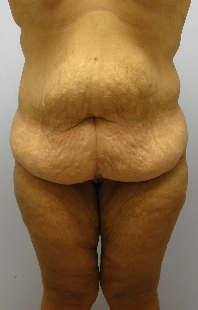 Body Lift Before & After Image