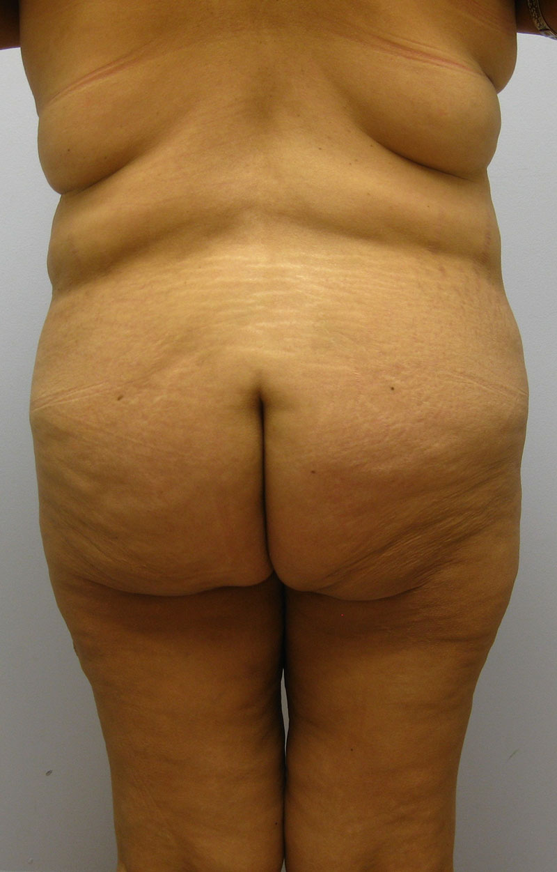 Body Lift Before & After Image