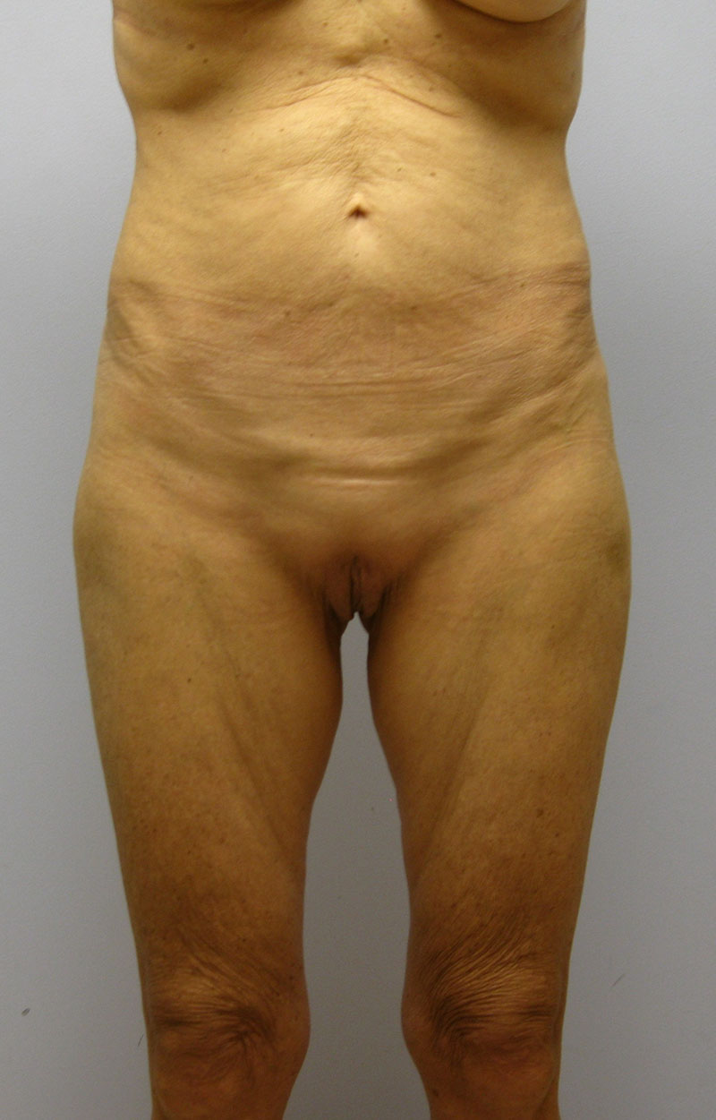 Body Lift Before & After Image