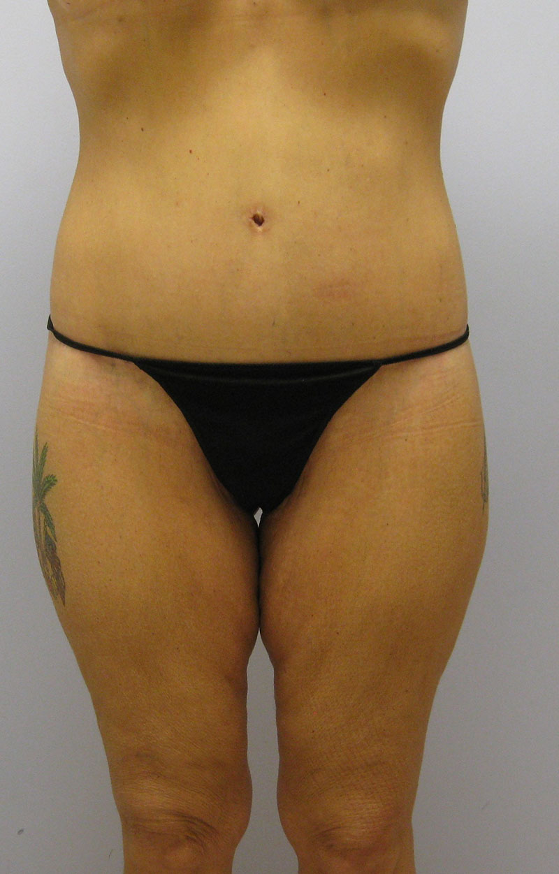 Body Lift Before & After Image