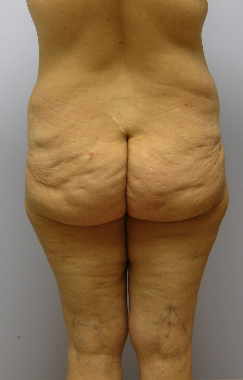 Body Lift Before & After Image