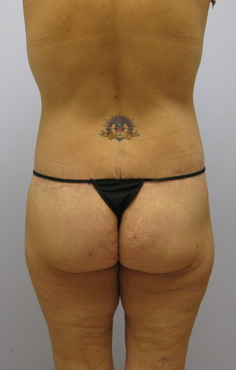 Body Lift Before & After Image