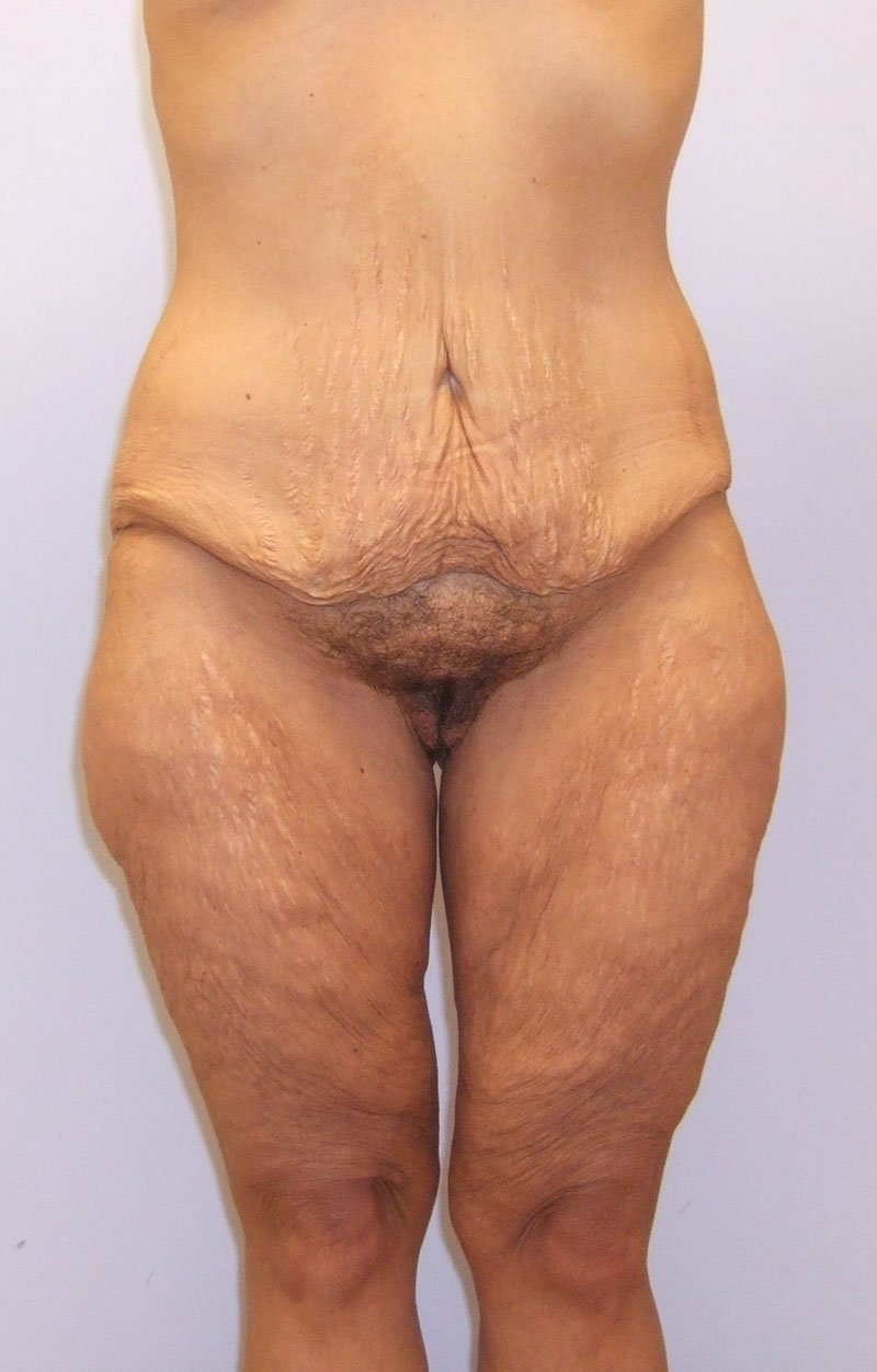 Body Lift Before & After Image