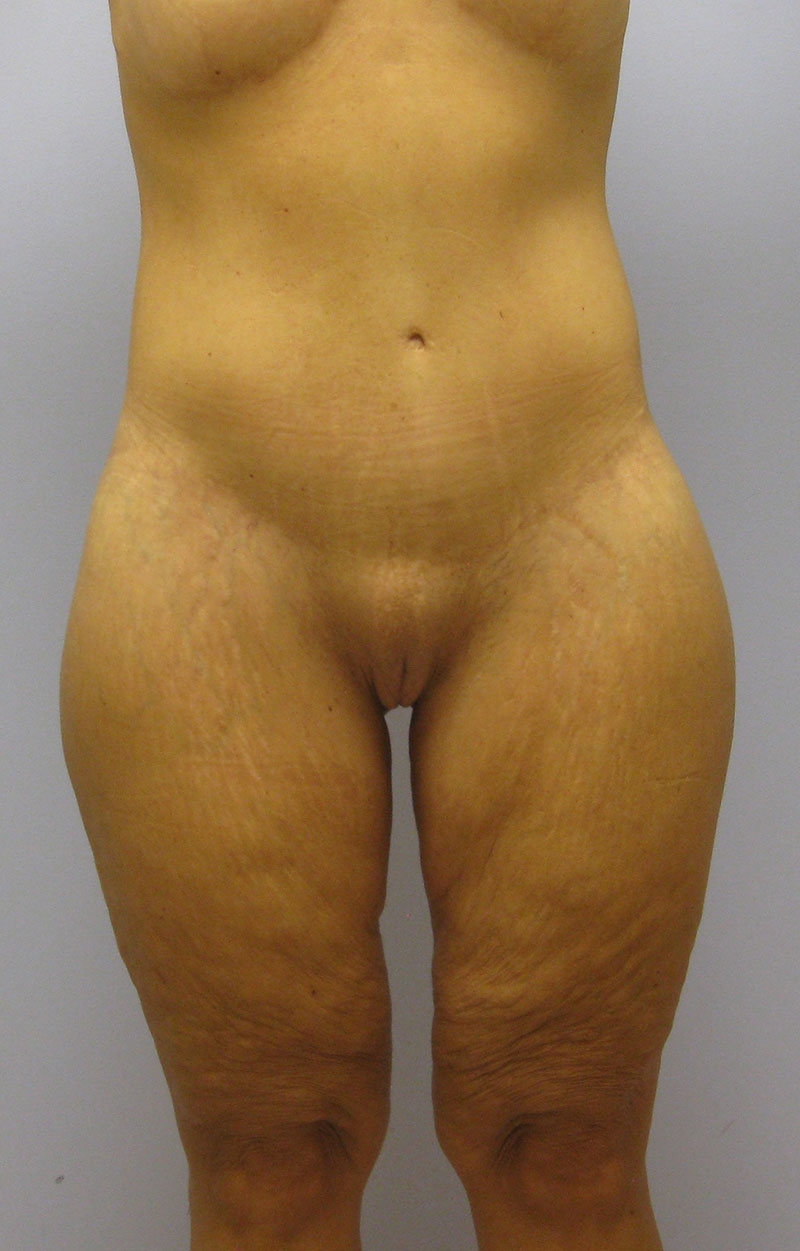 Body Lift Before & After Image