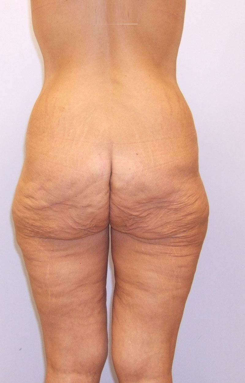 Body Lift Before & After Image