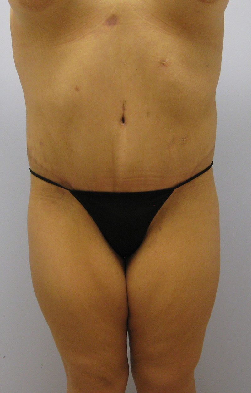 Body Lift Before & After Image