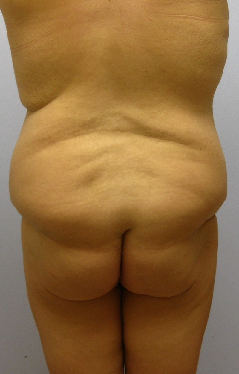 Body Lift Before & After Image