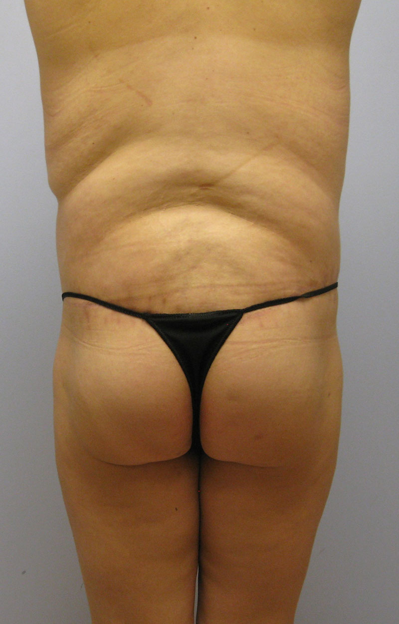 Body Lift Before & After Image