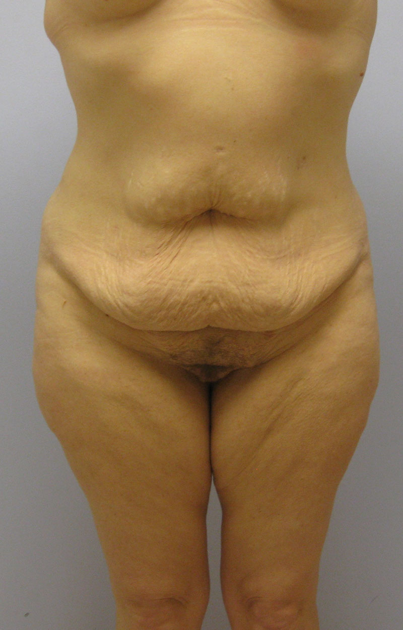 Body Lift Before & After Image