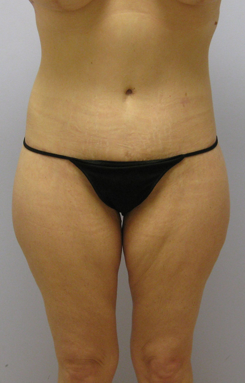 Body Lift Before & After Image