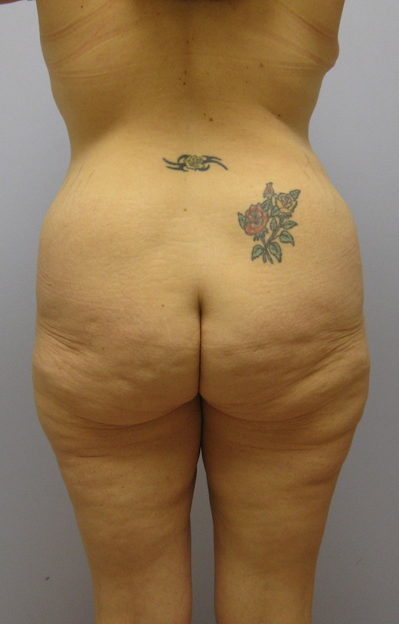 Body Lift Before & After Image