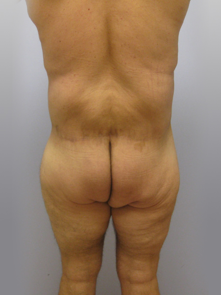 Body Lift Before & After Image