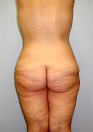 Buttock Lift Before & After Image