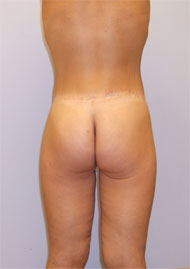 Buttock Lift Before & After Image