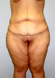 Buttock Lift Before & After Image