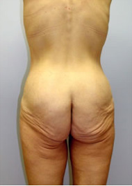 Buttock Lift Before & After Image