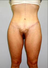 Buttock Lift Before & After Image