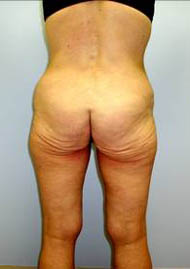 Buttock Lift Before & After Image