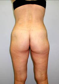 Buttock Lift Before & After Image