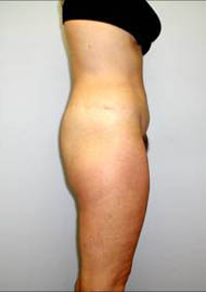 Buttock Lift Before & After Image