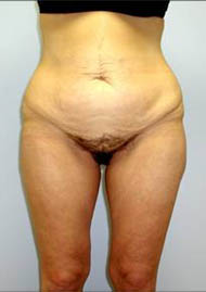 Buttock Lift Before & After Image