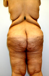 Buttock Lift Before & After Image