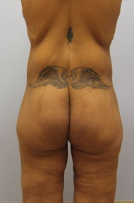 Buttock Lift Before & After Image