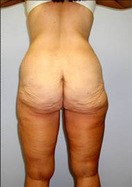 Buttock Lift Before & After Image