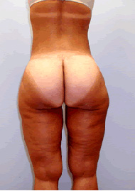 Buttock Lift Before & After Image