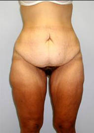 Buttock Lift Before & After Image