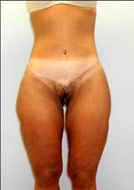 Buttock Lift Before & After Image