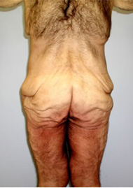 Buttock Lift Before & After Image