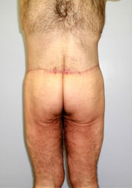 Buttock Lift Before & After Image